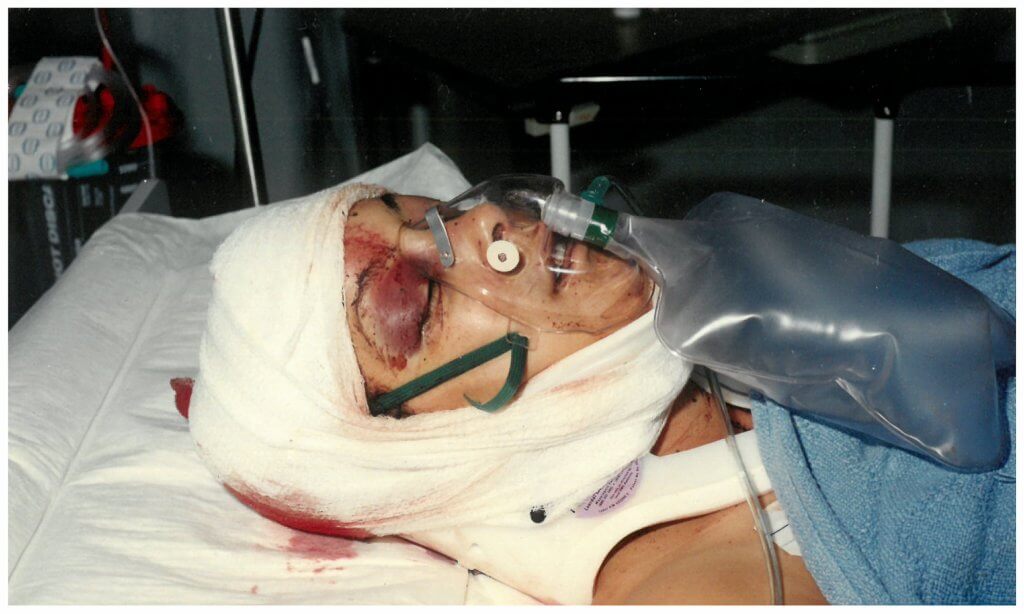 ICU headshot of Monique recovering in the hospital after her near-fatal wounds. The injuries to her head included a basilar skull fracture and six centimeter and eight centimeter lacerations to her scalp. Photo taken by the Jacksonville Police evidence team.